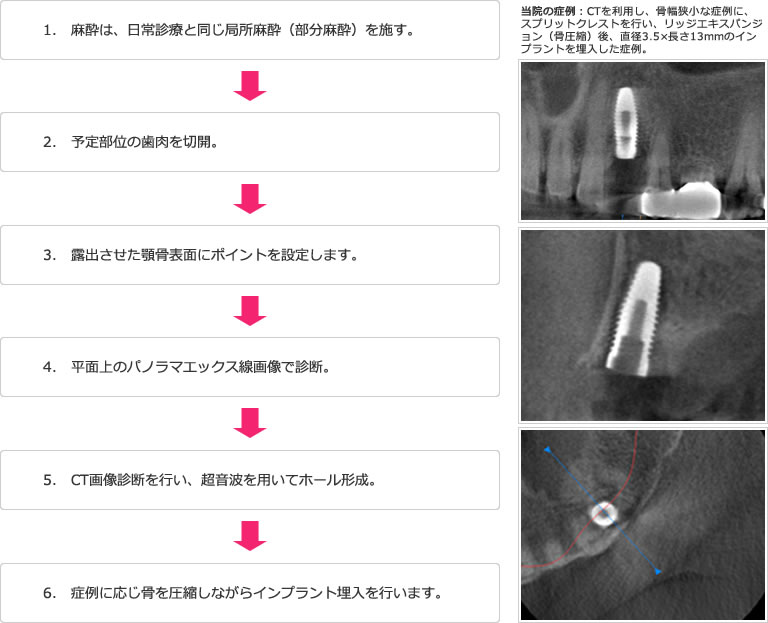 インプラント治療の手順