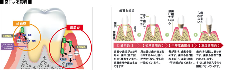 歯周病図による説明